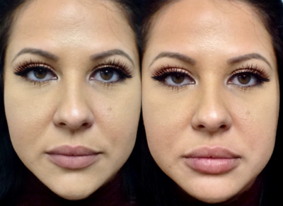 Lip Fillers before and after photo
