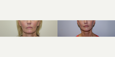 Lip Fillers before and after photo