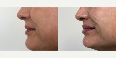 Lip Fillers before and after photo