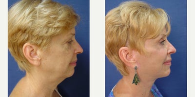 Neck Lift before and after photo