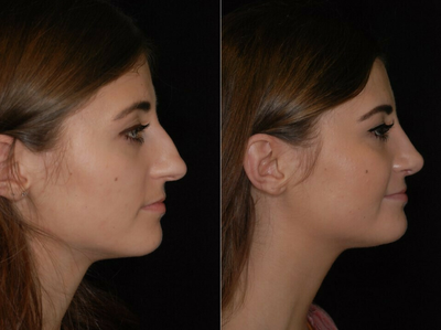 Rhinoplasty before and after photo