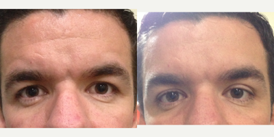 Botox before and after photo