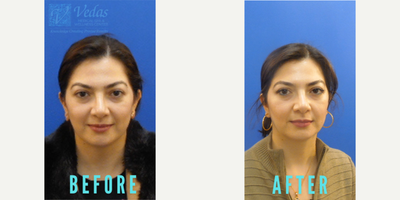 Botox before and after photo