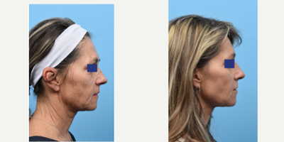 Dermal Fillers before and after photo