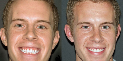 Gum Lift before and after photo