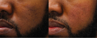 Infini RF before and after photo