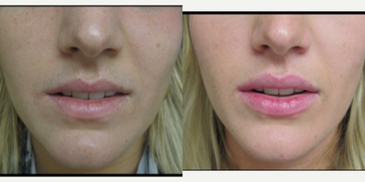Lip Fillers before and after photo