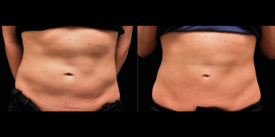 CoolSculpting before and after photo