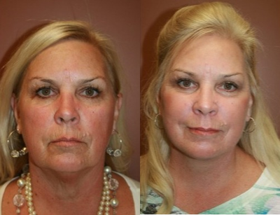 Facelift before and after photo