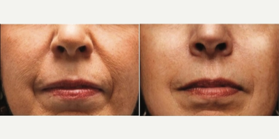 Dermal Fillers before and after photo