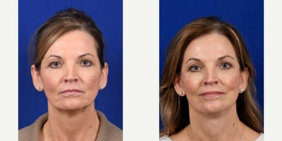Eyelid Surgery before and after photo