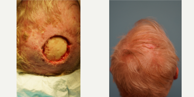 Facial Reconstructive Surgery before and after photo