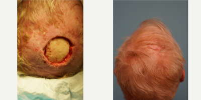 Facial Reconstructive Surgery before and after photo