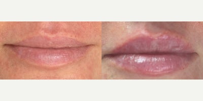 Juvederm before and after photo