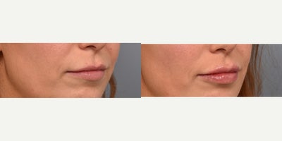 Lip Fillers before and after photo