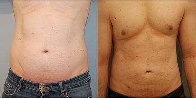 Liposuction before and after photo