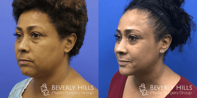 Neck Lift before and after photo