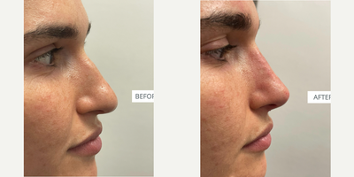 Nonsurgical Nose Job before and after photo