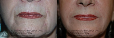 Restylane before and after photo