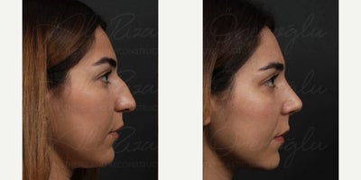 Rhinoplasty before and after photo
