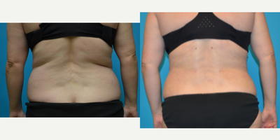 Smart Lipo before and after photo