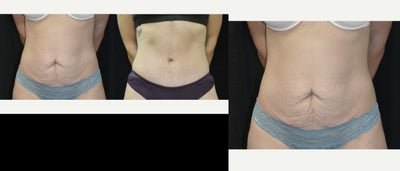 Tummy Tuck before and after photo