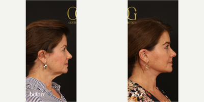 Brow Lift before and after photo