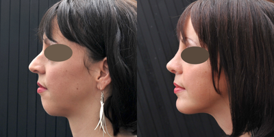 Chin Implant before and after photo