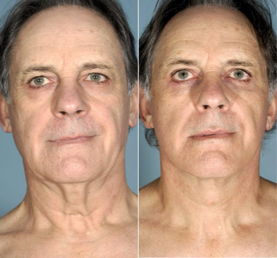 Neck Lift before and after photo