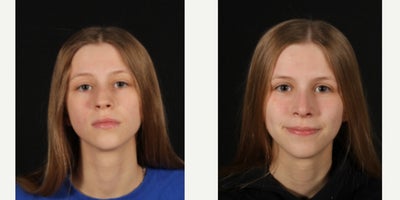 Revision Rhinoplasty before and after photo