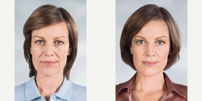 Sculptra before and after photo