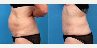 Tummy Tuck before and after photo