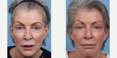 CO2 Laser before and after photo