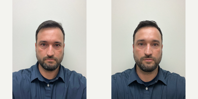 Skin Rejuvenation before and after photo