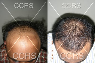 Hair Transplant before and after photo