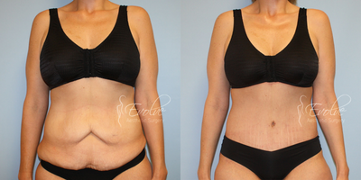 Liposuction before and after photo