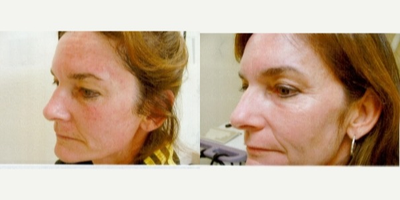 Photodynamic Therapy before and after photo
