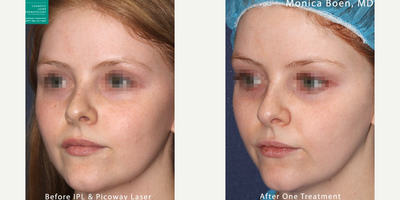 PicoWay before and after photo