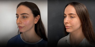 Rhinoplasty before and after photo