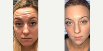 Botox before and after photo