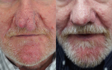 CO2 Laser before and after photo