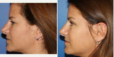 Eyelid Surgery before and after photo