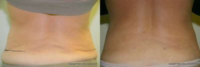 Liposculpture before and after photo