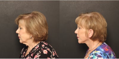 before and after image