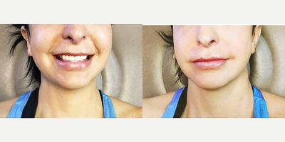 Restylane before and after photo
