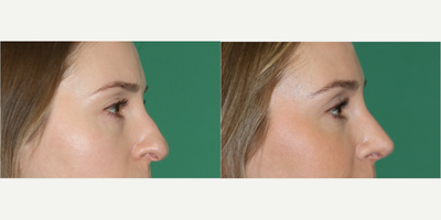 Rhinoplasty before and after photo
