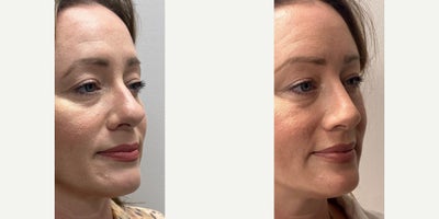 Rhinoplasty before and after photo