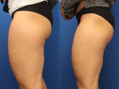 SculpSure before and after photo
