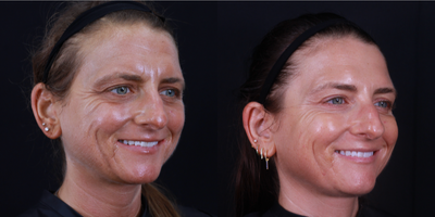 Botox before and after photo