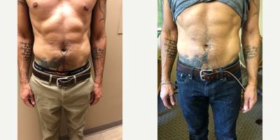 Emsculpt before and after photo
